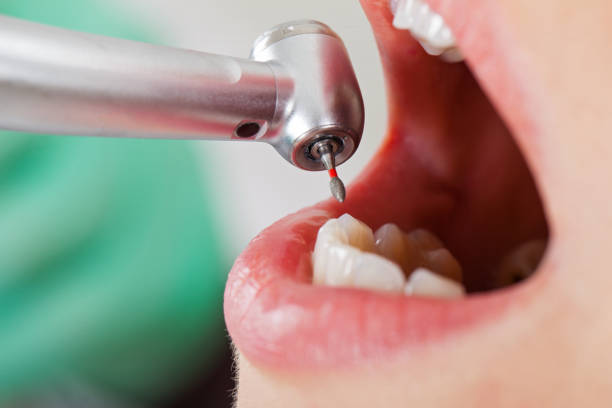 Best Emergency Root Canal Treatment in Etowah, NC